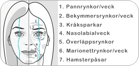 Områden på ansiktet som kan korrigeras med hjälp av Botox